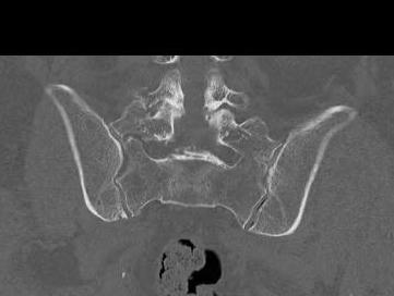 Sacral Insufficiency Fracture